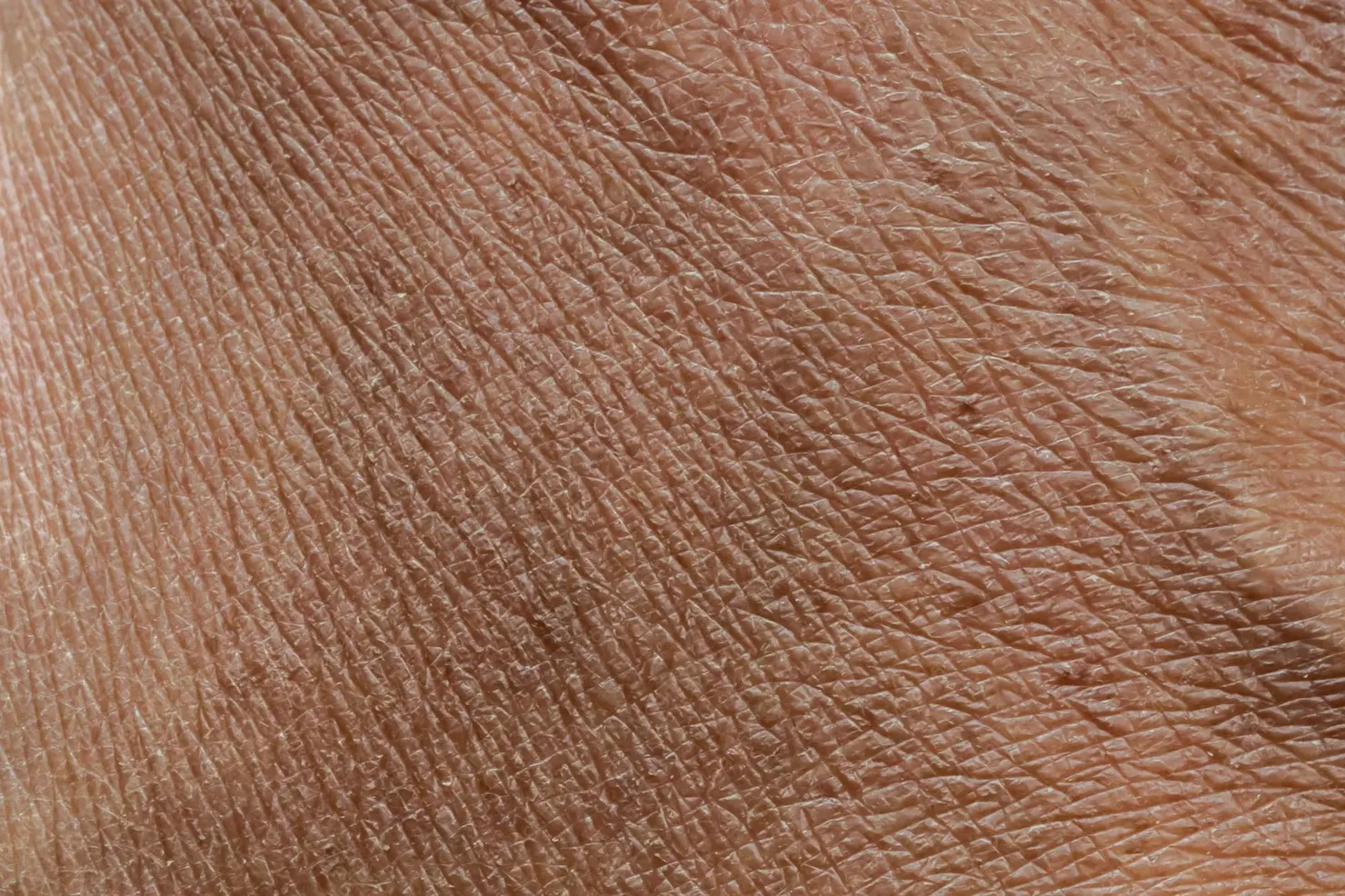 Dry skin