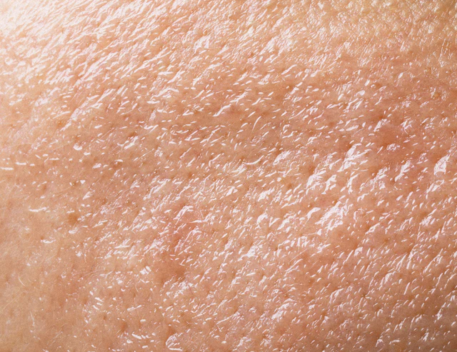Oily and clogged skin